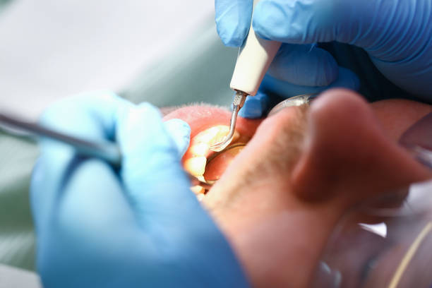 Best Emergency Tooth Extraction in Childress, TX
